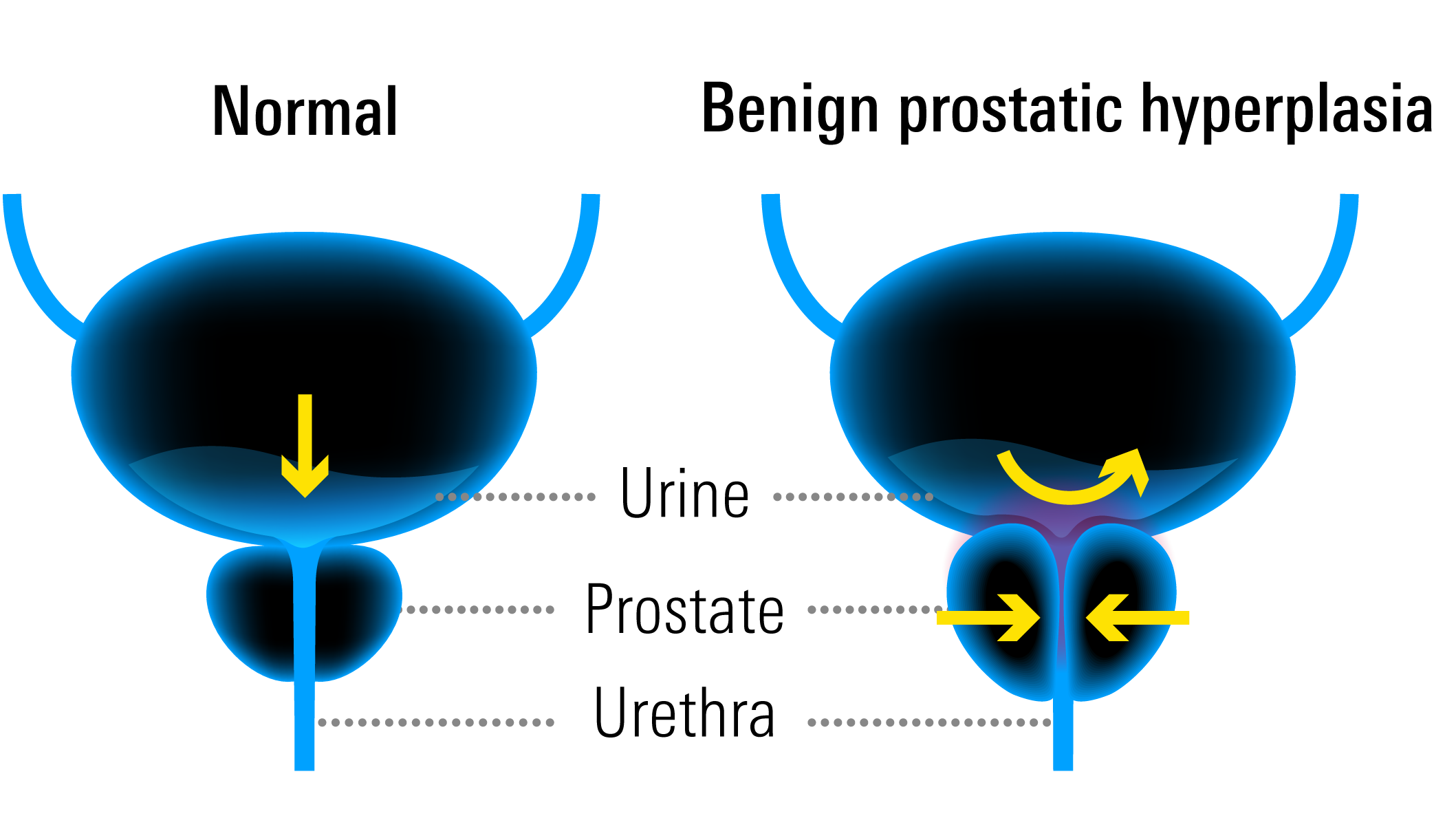Illustration of benign prostate hyperplasia