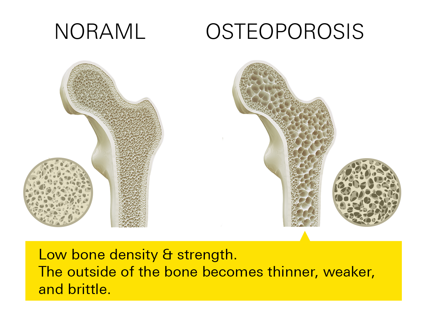 Normal vs Osteoporosis Bones
