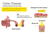 Celiac Disease