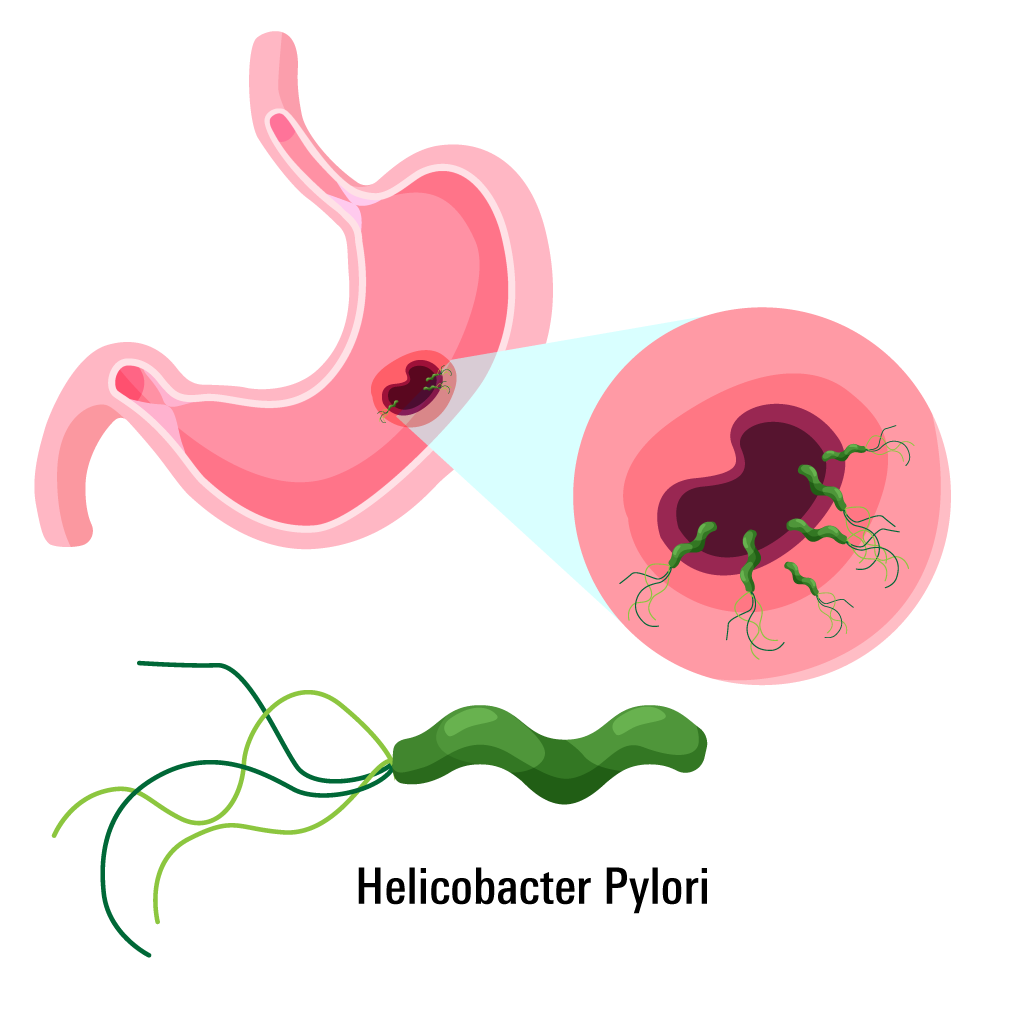 Helicobacter pylori related ulcer