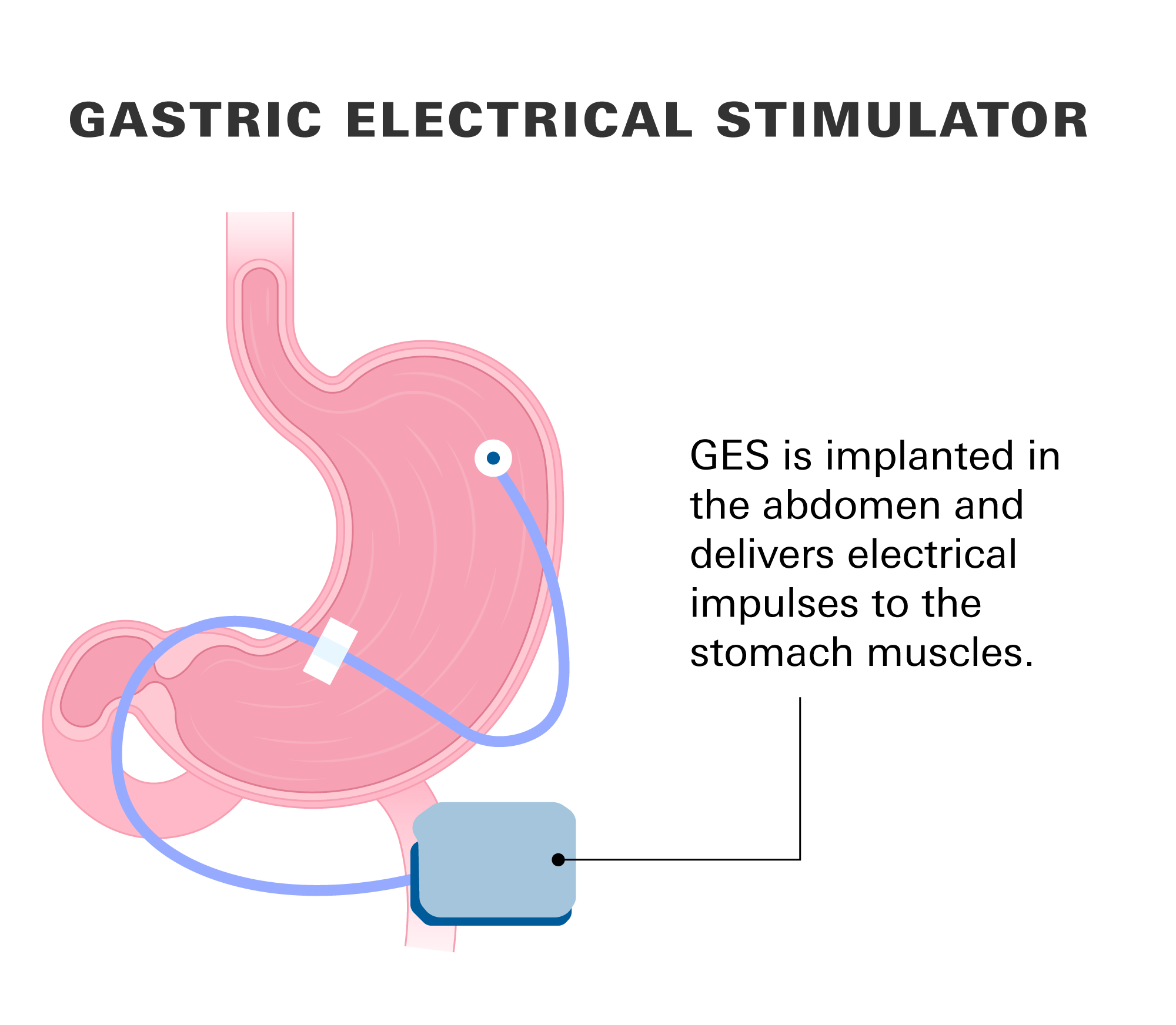 Gastric electrical stimulator