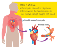 Angina Pectoris