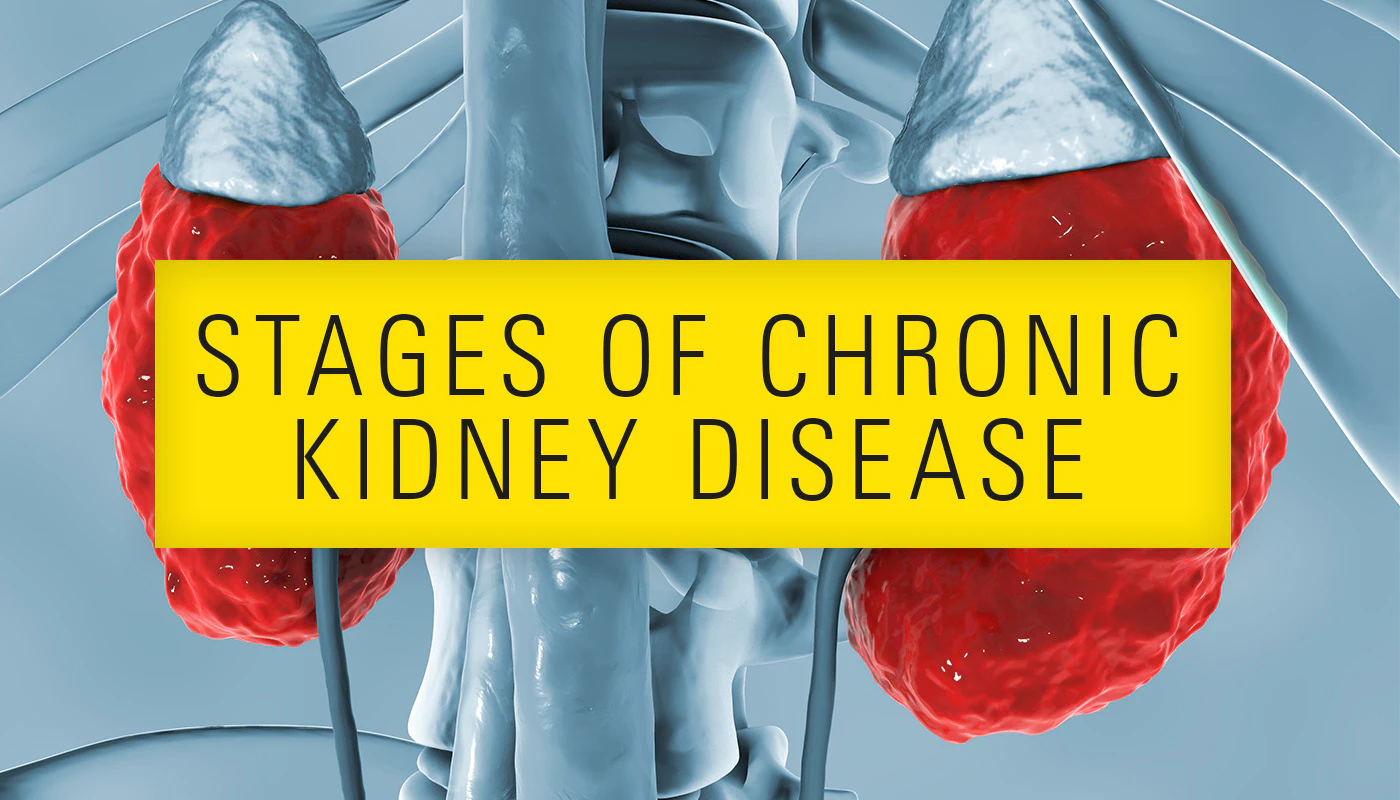 Stages of Chronic Kidney Disease