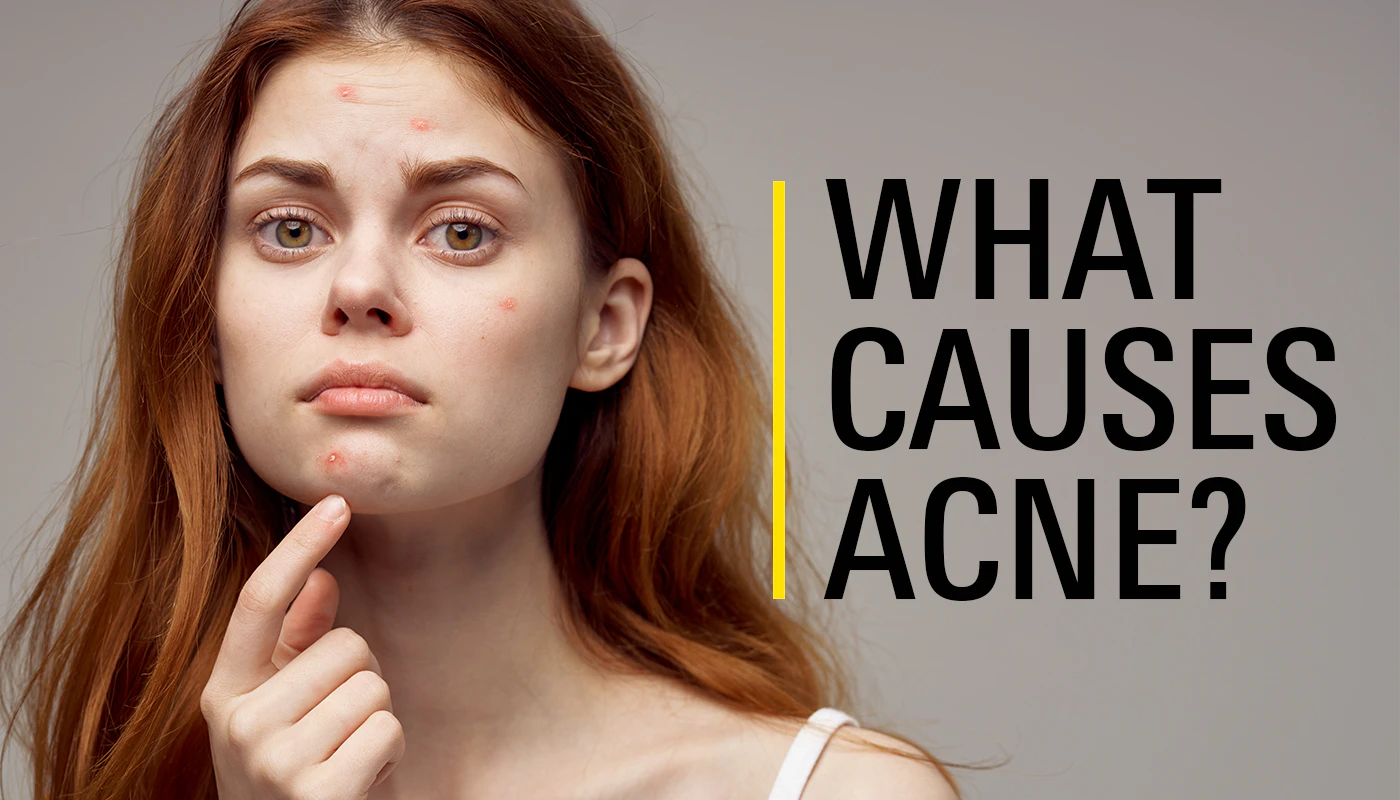 what-causes-acne