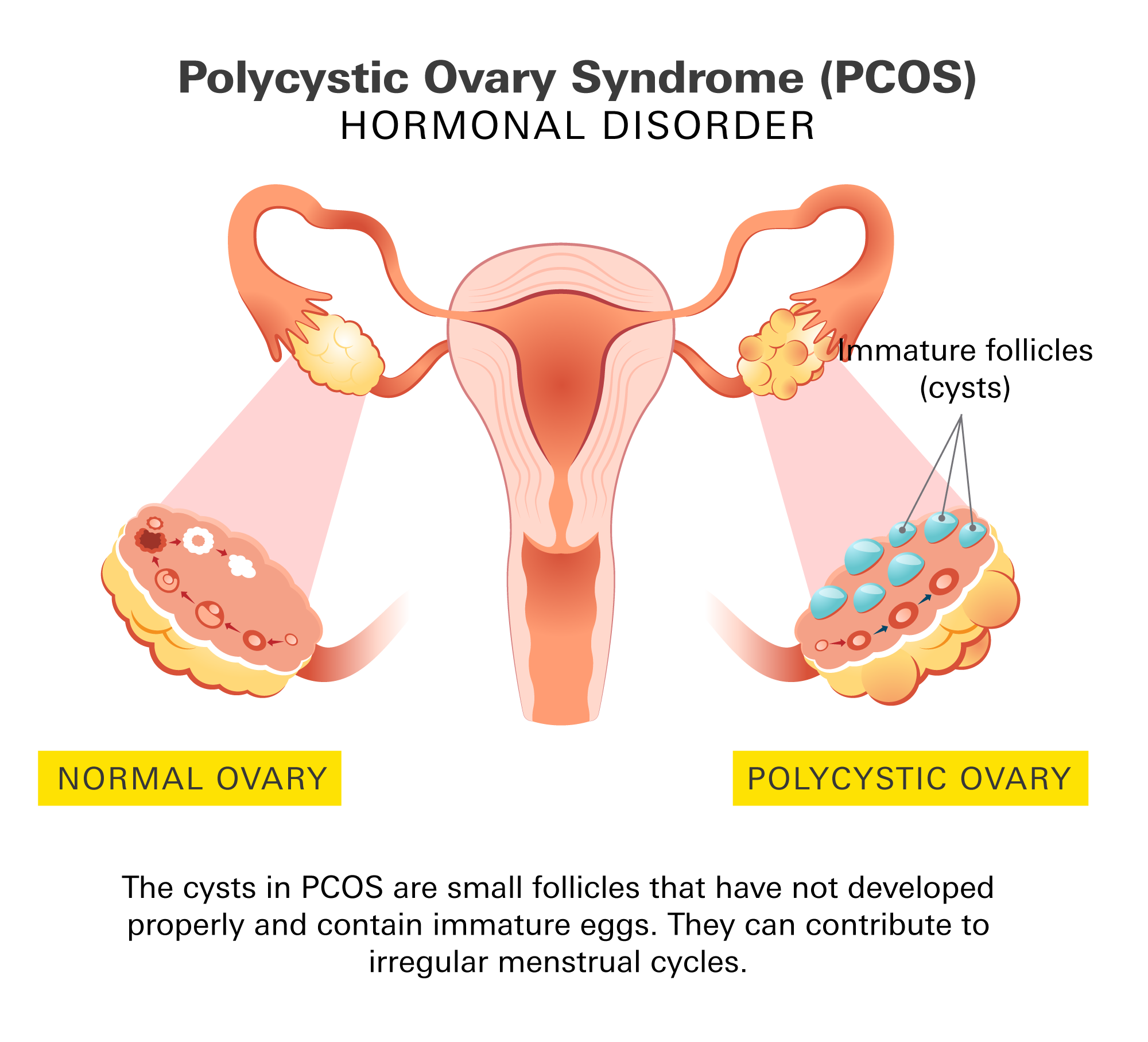 Polycystic ovary